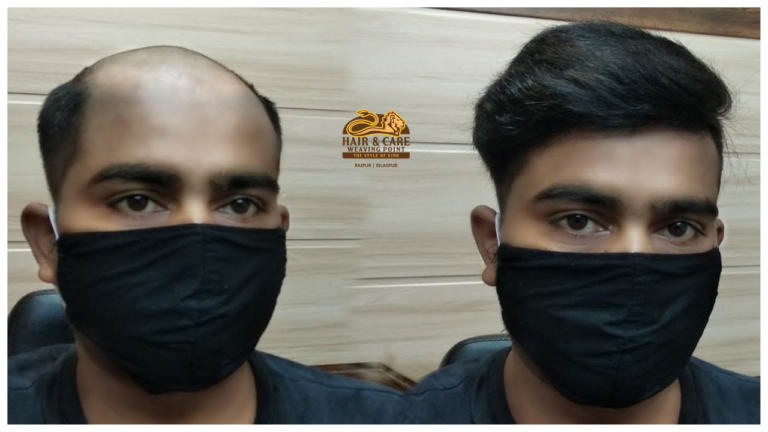 Hair patch in raipur