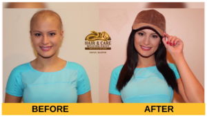Hair Extensions - non-surgical hair replacement services