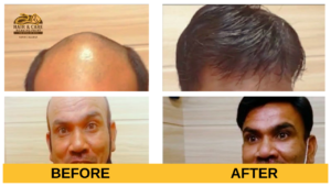 Non-surgical hair replacement services