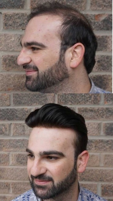 Hair patch before and after